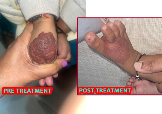 Hemangioma Treatment