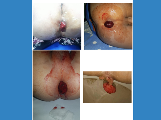 Prolapsed Rectal Polyp