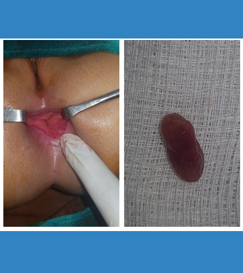 Solitary Rectal Polyp