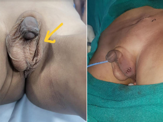 Undescended Testis Treatment